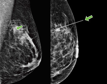 a breast with a green arrow pointing to the left side