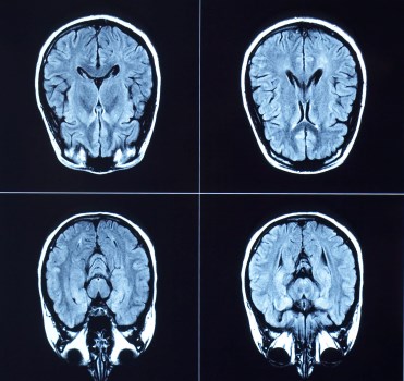 brain MRI