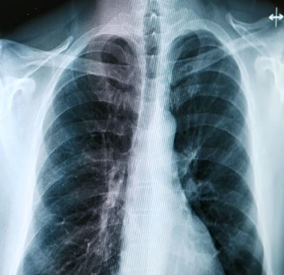 a chest xray 