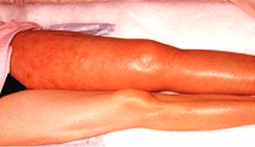 a leg affected by venous thromboembolism