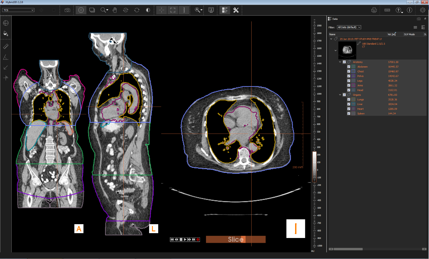 Example Hybrid3D screen capture demonstrating low dose whole body CT scan with automatically generated anatomical (head, arms, legs, abdomen, chest and pelvis) and organ (lungs, liver, mediastinum and spleen) segmentation.