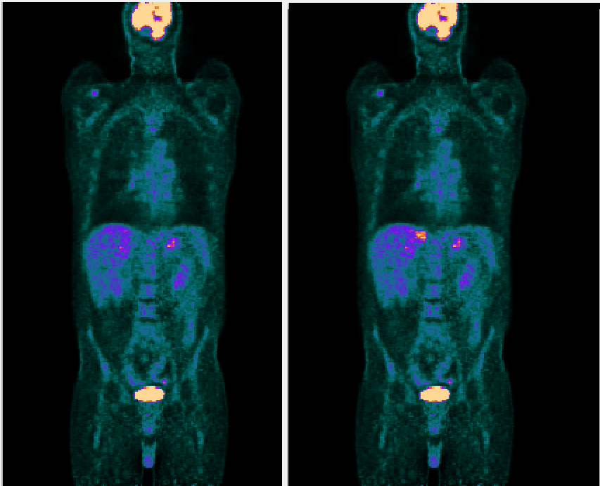 Example FDG PET scan before (left) and after (right) synthesis of a lesion with known size, location and activity.