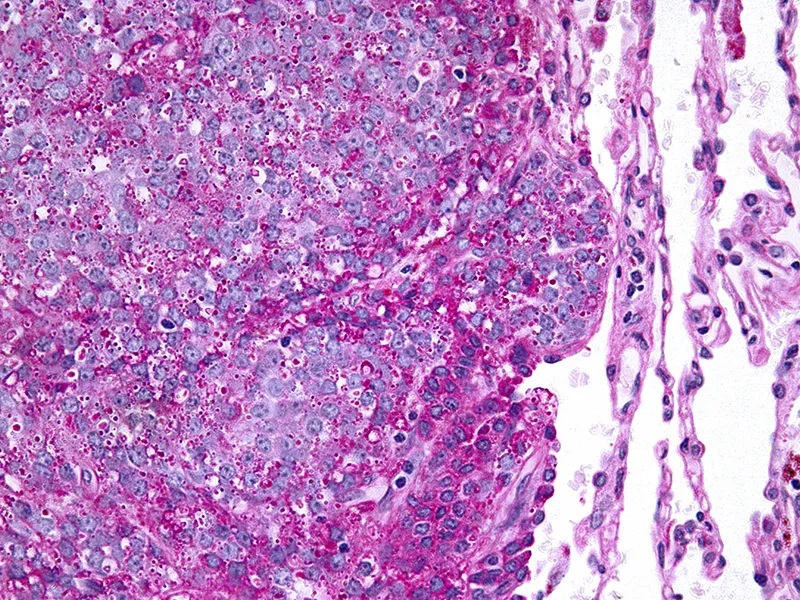 Ewing sarcoma tissue viewed under a microscope. Nephron/Wikimedia Commons (CC BY-SA 3.0).
