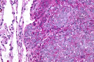 Ewing sarcoma tissue viewed under a microscope. Nephron/Wikimedia Commons (CC BY-SA 3.0).
