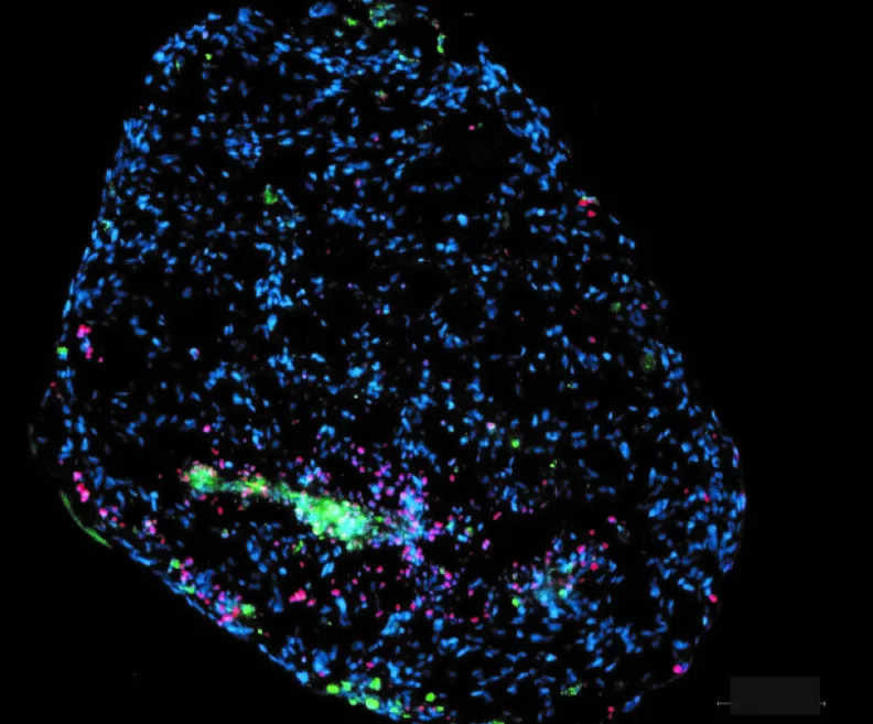 Un fragment de tumeur cérébrale humaine cultivée en laboratoire, coloré en différentes couleurs.
