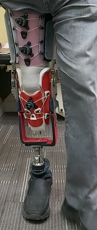 Example of trans tibial prosthesis