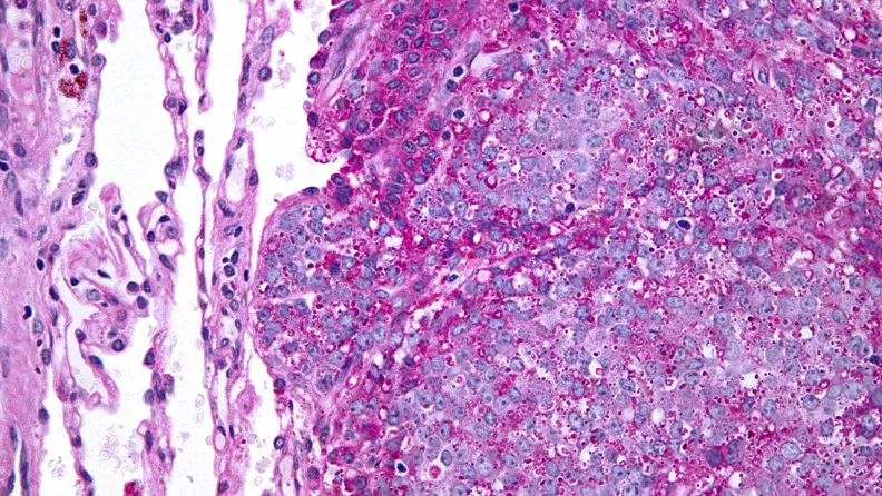 Ewing sarcoma tissue viewed under a microscope. Nephron/Wikimedia Commons (CC BY-SA 3.0).